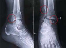 【医疗科普】踝关节骨折的主要类型及其影像学表现