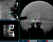 机器人辅助腰椎后路侧弯矫形手术方案解析