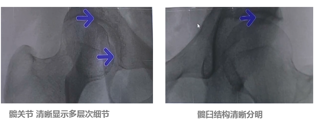 平板小C髋关节成像效果