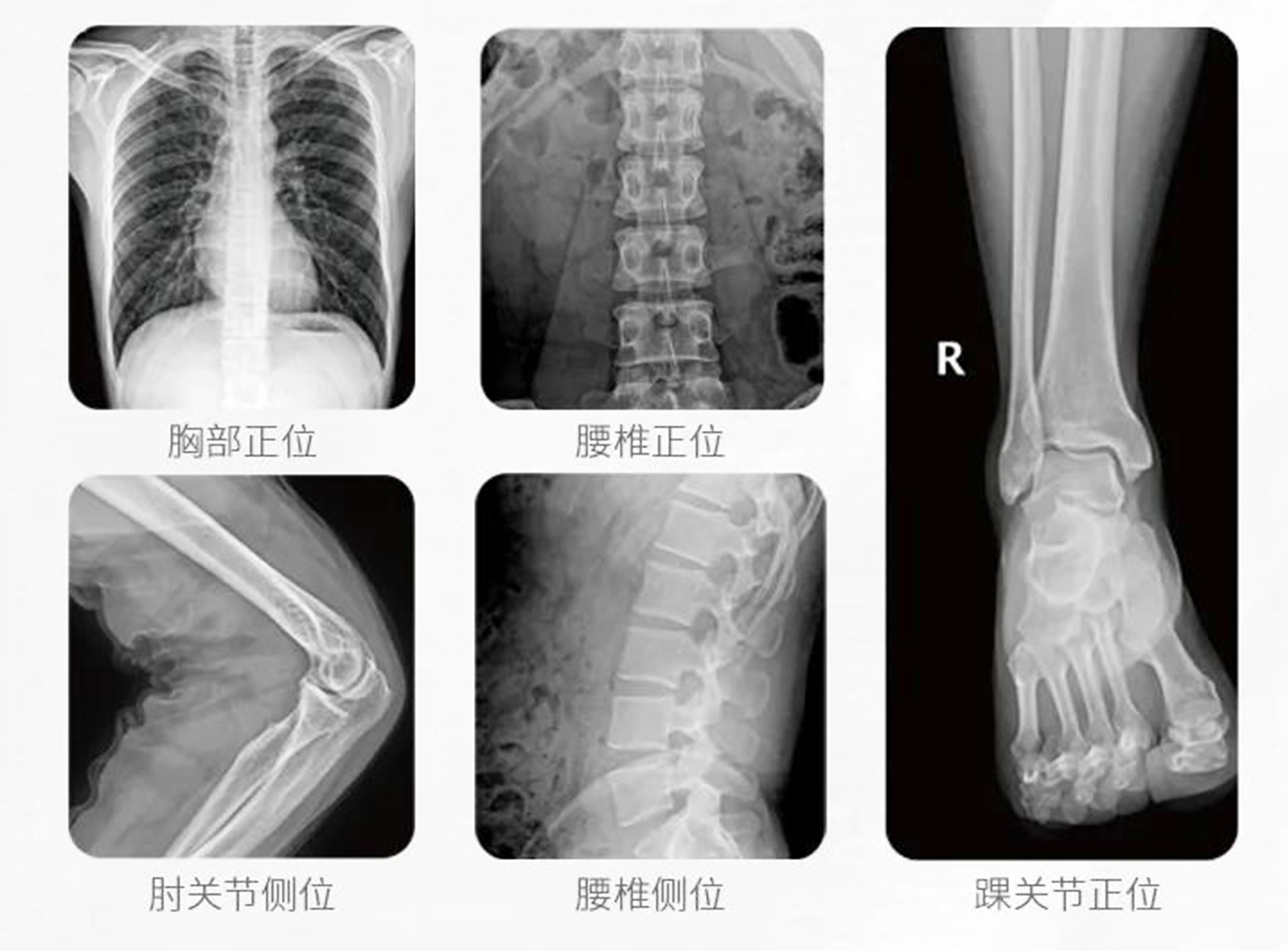 大功率移动DR临床影像