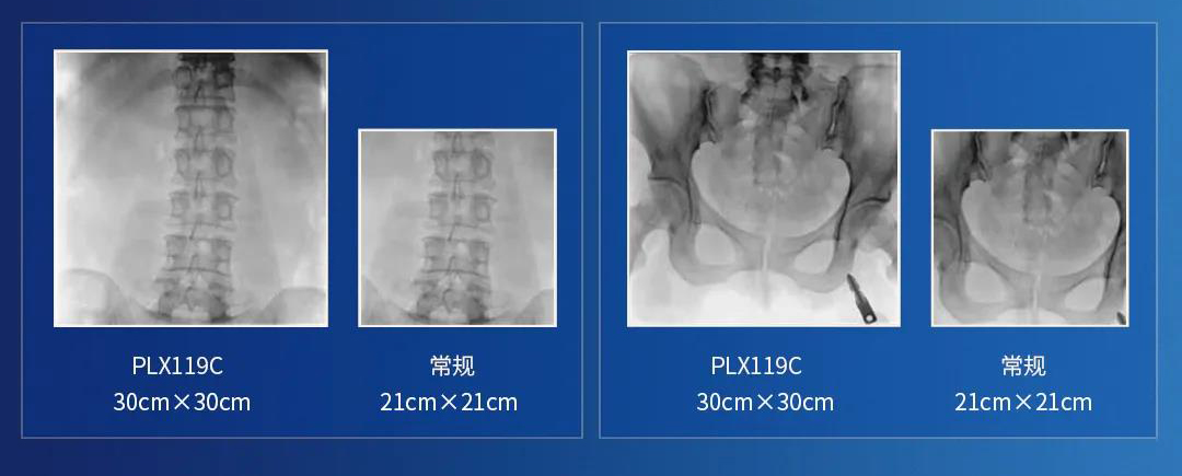 大平板C形臂视野翻倍