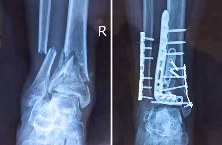 【医疗科普】：关节内的骨折