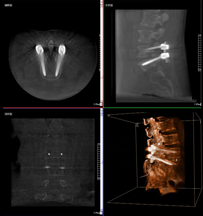 移动式三维C形臂临床影像