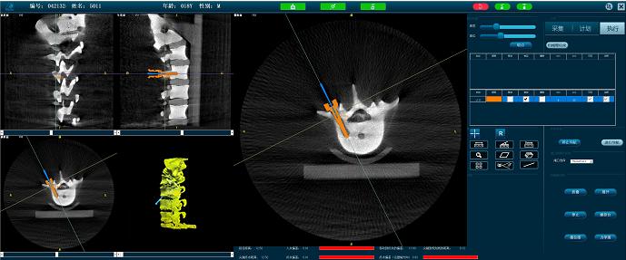脊柱微创手术机器人-定位准确