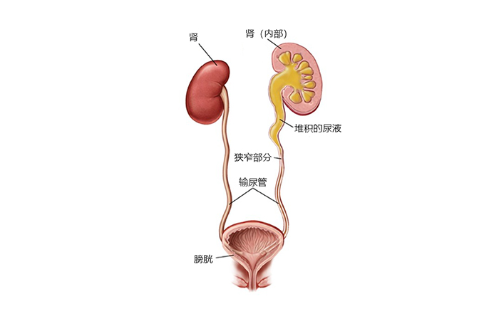输尿管狭窄导致尿液堆积
