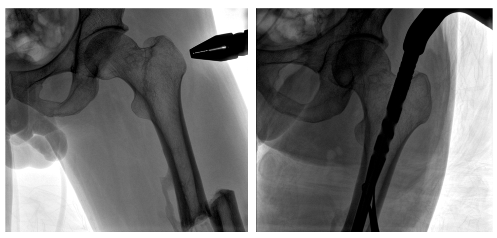 一体式C形臂钉点至骨折部位的临床影像