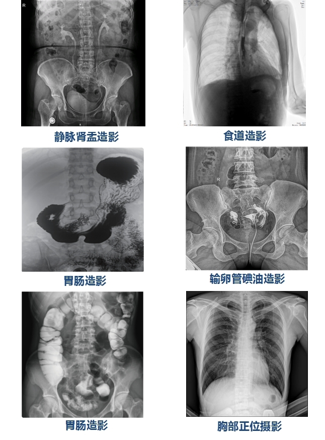 85kW大功率u臂平板dr机PLX8500F-500μ临床图像