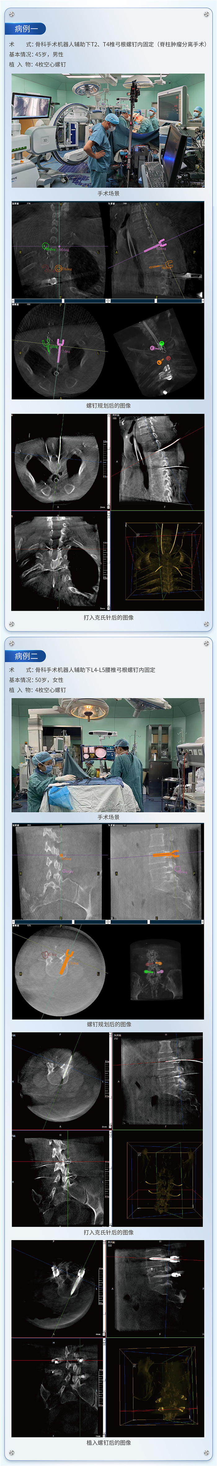 脊柱外科手术导航定位系统应用下的病例分享