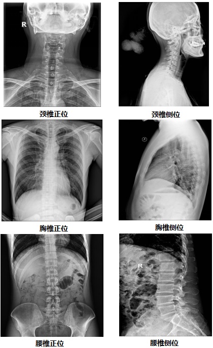 固定悬吊dr-PLD7800E部分临床效果图