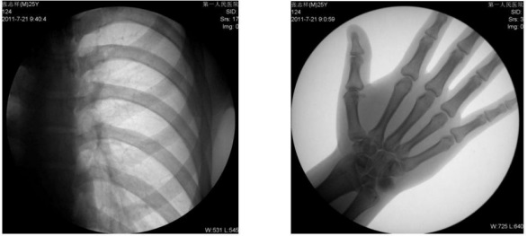双床双管胃肠x线机临床影像