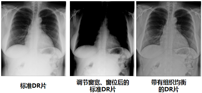 DR图像质量对比图