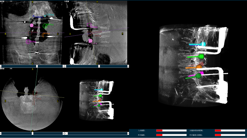 机器人辅助腰椎后路侧弯矫形手术三维图像
