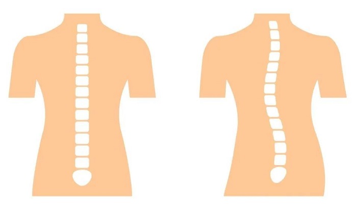 正常脊柱和脊柱侧弯的对比